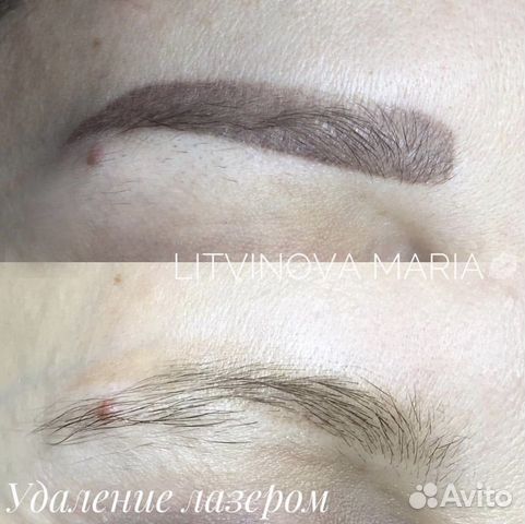 Удаление татуажа